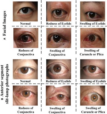 An ensemble deep learning diagnostic system for determining Clinical Activity Scores in thyroid-associated ophthalmopathy: integrating multi-view multimodal images from anterior segment slit-lamp photographs and facial images